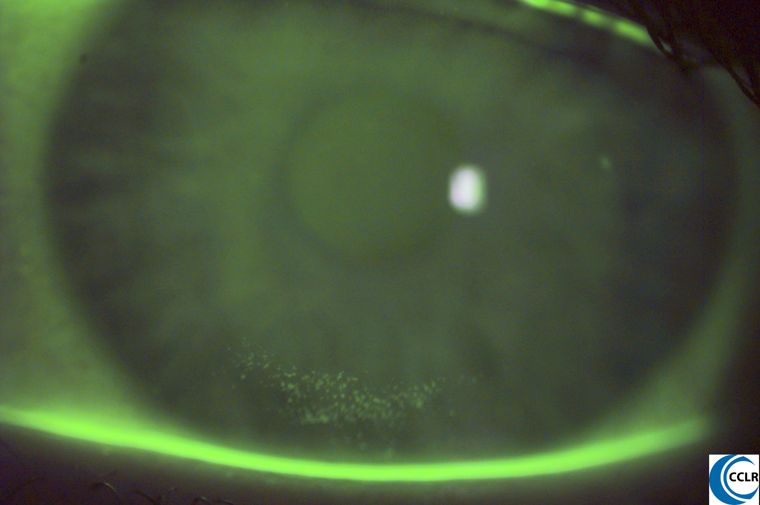 Corneal Staining Contact Lens Update