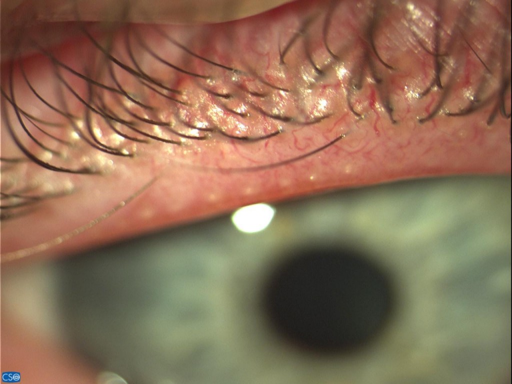 One day Silicone Hydrogel As A Therapeutic Lens In A Severely One day Silicone Hydrogel As A Therapeutic Lens In A Severely