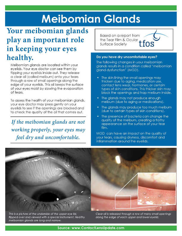 Patient Handout Meibomian gland dysfunction Contact Lens Update
