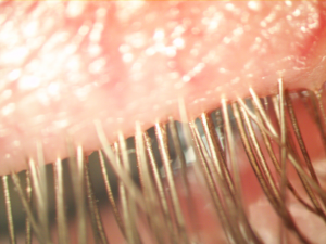 Figure 10: immediately post-treatment