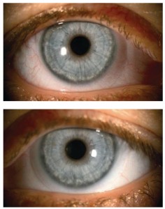Same patient wearing a hydrogel DD lens in the right eye (top) and a SiHy DD lens in the left eye (bottom) for an eight-hour period, with a noticeable difference in limbal hyperaemia. (Images courtesy of Dr Shehzad Naroo). Taken from Jones & Woods. 16