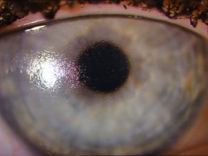 Poor wetting SiHy DD in a female patient. The lens has been worn for only 3 hours and shows marked deposition and poor wettability.