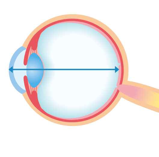 Contact Lens Update | Clinical insights based in current research