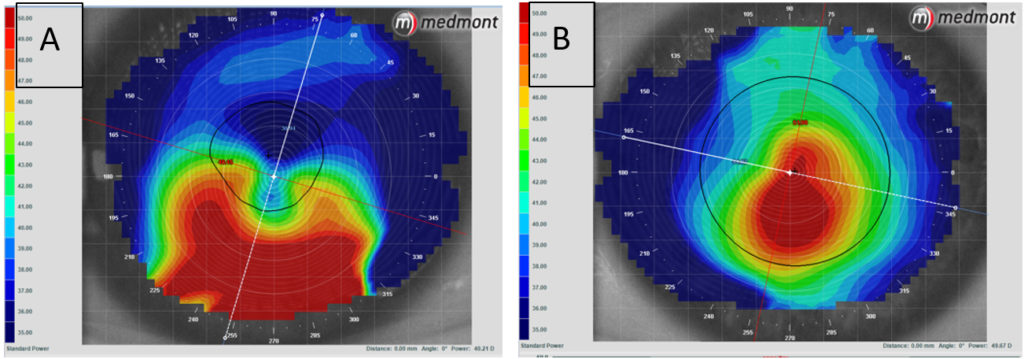 Corneal Ectatic Diseases – A Review Of The Latest Treatments, Including ...