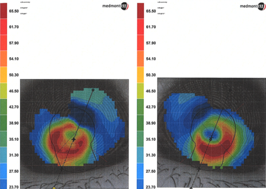 Reclaiming Vision In Dry-Eye Syndrome