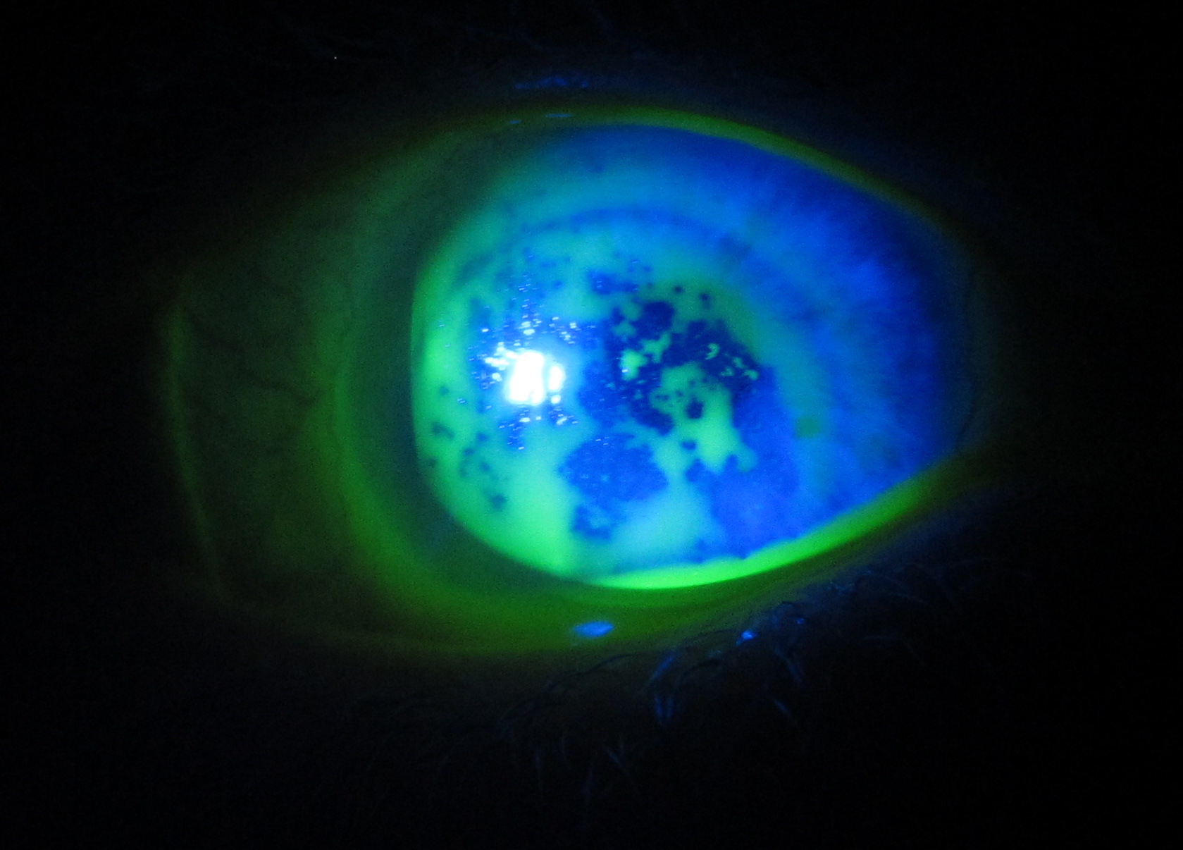 Troubleshooting scleral lens cases for improved performance Contact Lens Update
