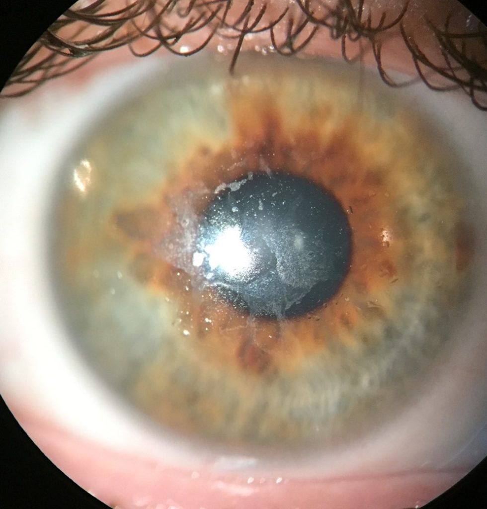 Article Review: How Can We Best Measure the Performance of Scleral ...